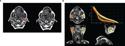 MR-Guided Radiotherapy for Head and Neck Cancer: Current Developments, Perspectives, and Challenges